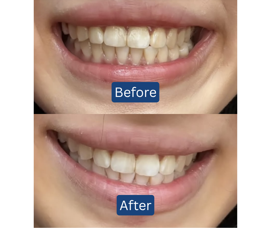 11.11 BIGGEST DEAL! RM3 for 3 Toothpowder💎