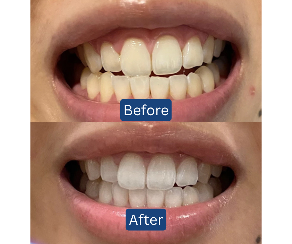 11.11 BIGGEST DEAL! RM3 for 3 Toothpowder💎