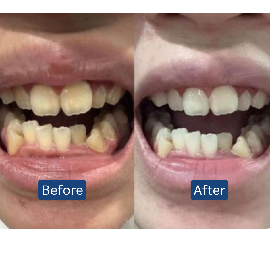 11.11 BIGGEST DEAL! RM3 for 3 Toothpowder💎